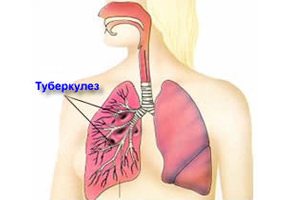 24 березня – відзначається день боротьби з туберкульозом