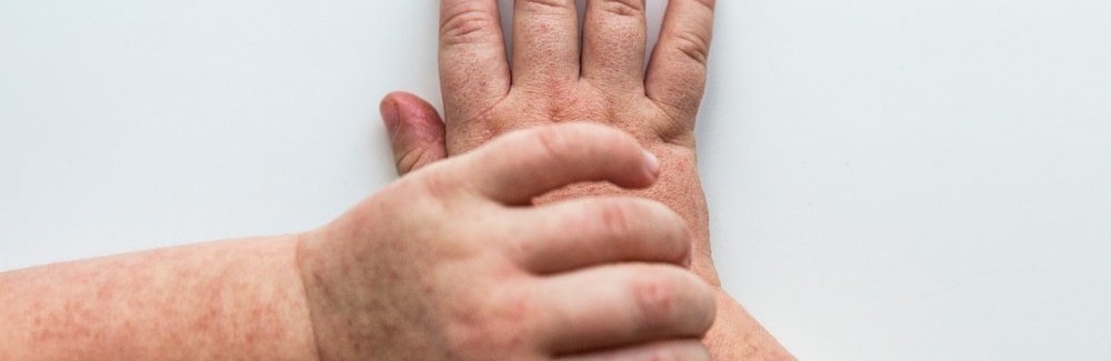 Що треба знати про скарлатину