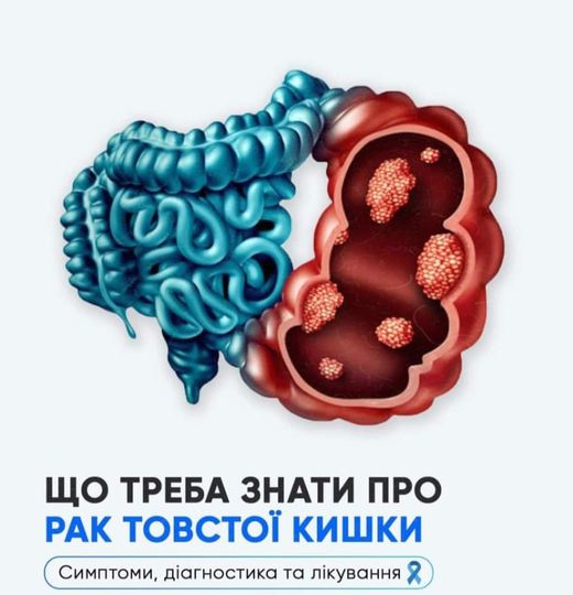 Що треба знати про рак товстої кишки