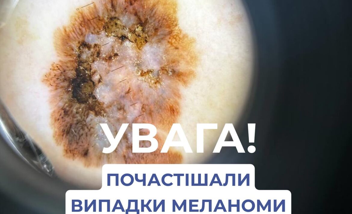 Увага‼️ Почастішали випадки меланоми