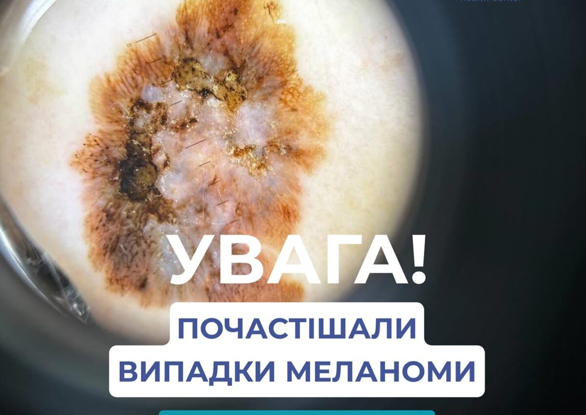 Увага‼️ Почастішали випадки меланоми