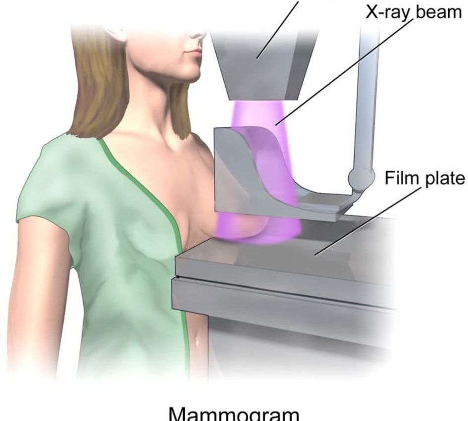 Мамографія (мамографічне обстеження). Чи треба боятись цього обстеження?