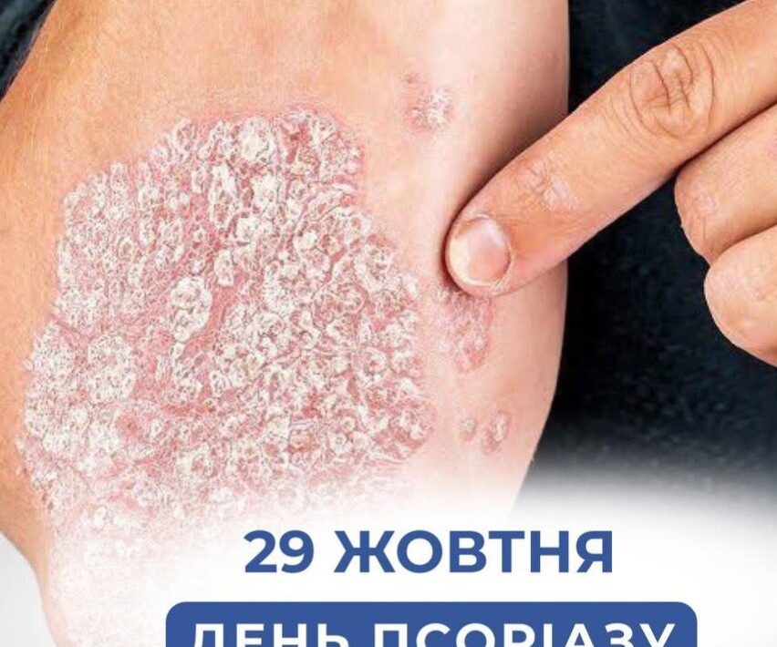 29 жовтня — Всесвітній день боротьби з псоріазом